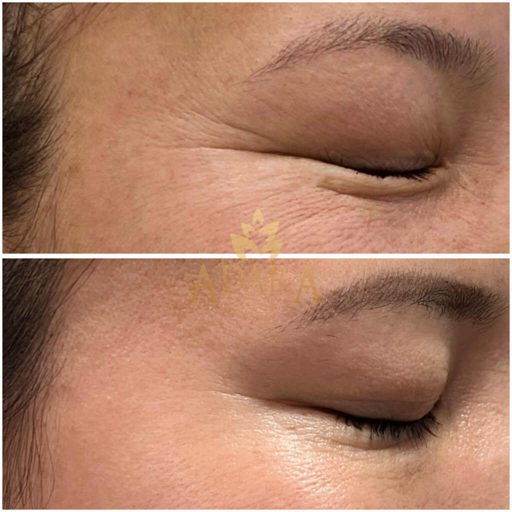 Crow’s feet botox 17-04-2024