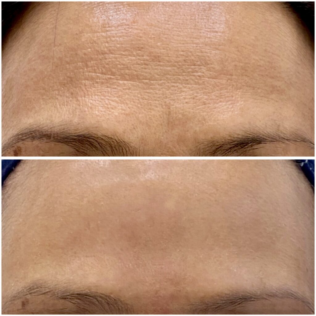 Forehead Botox 13-03-2024