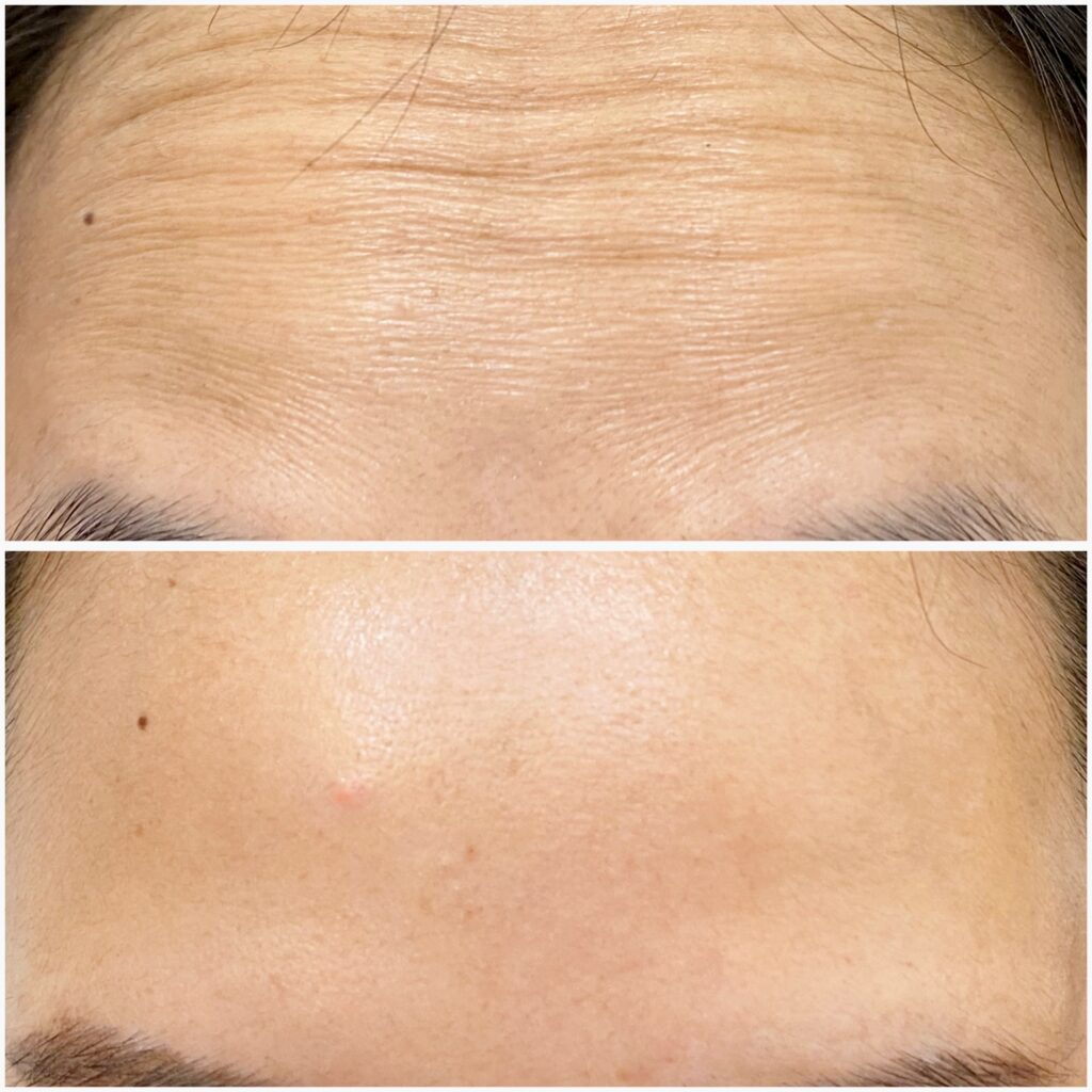 Forehead botox after 2 weeks 29-02-2024