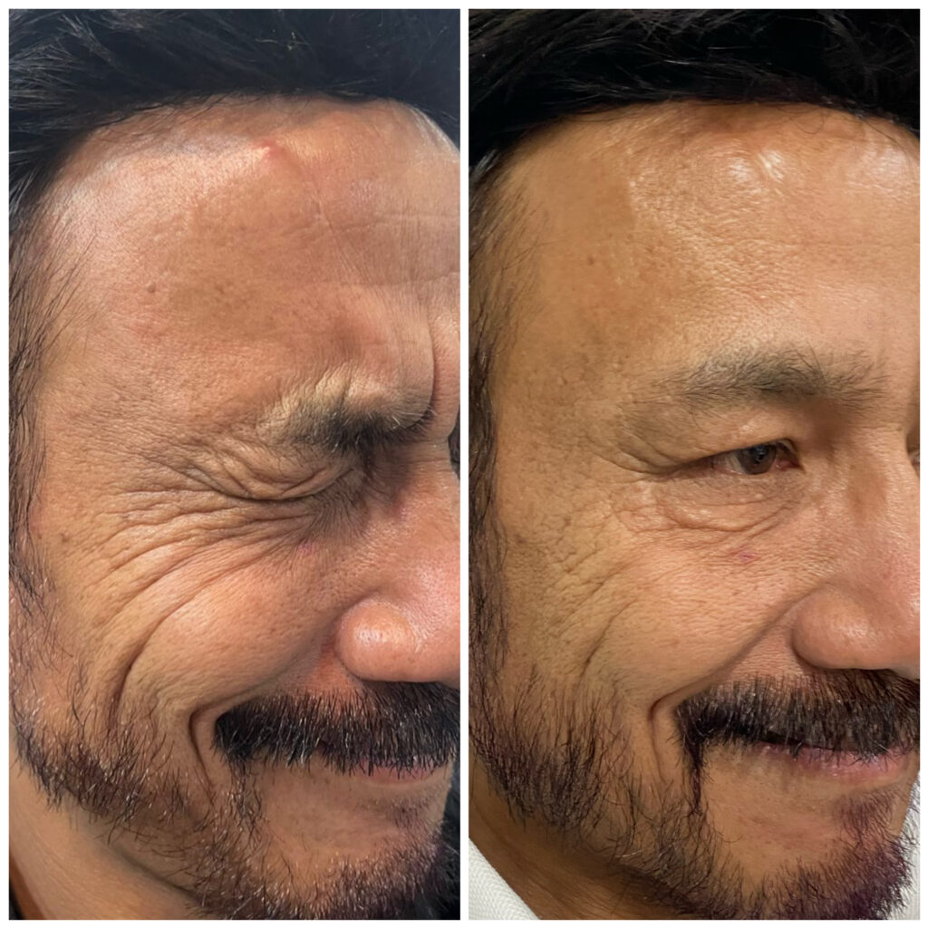 Full face botox