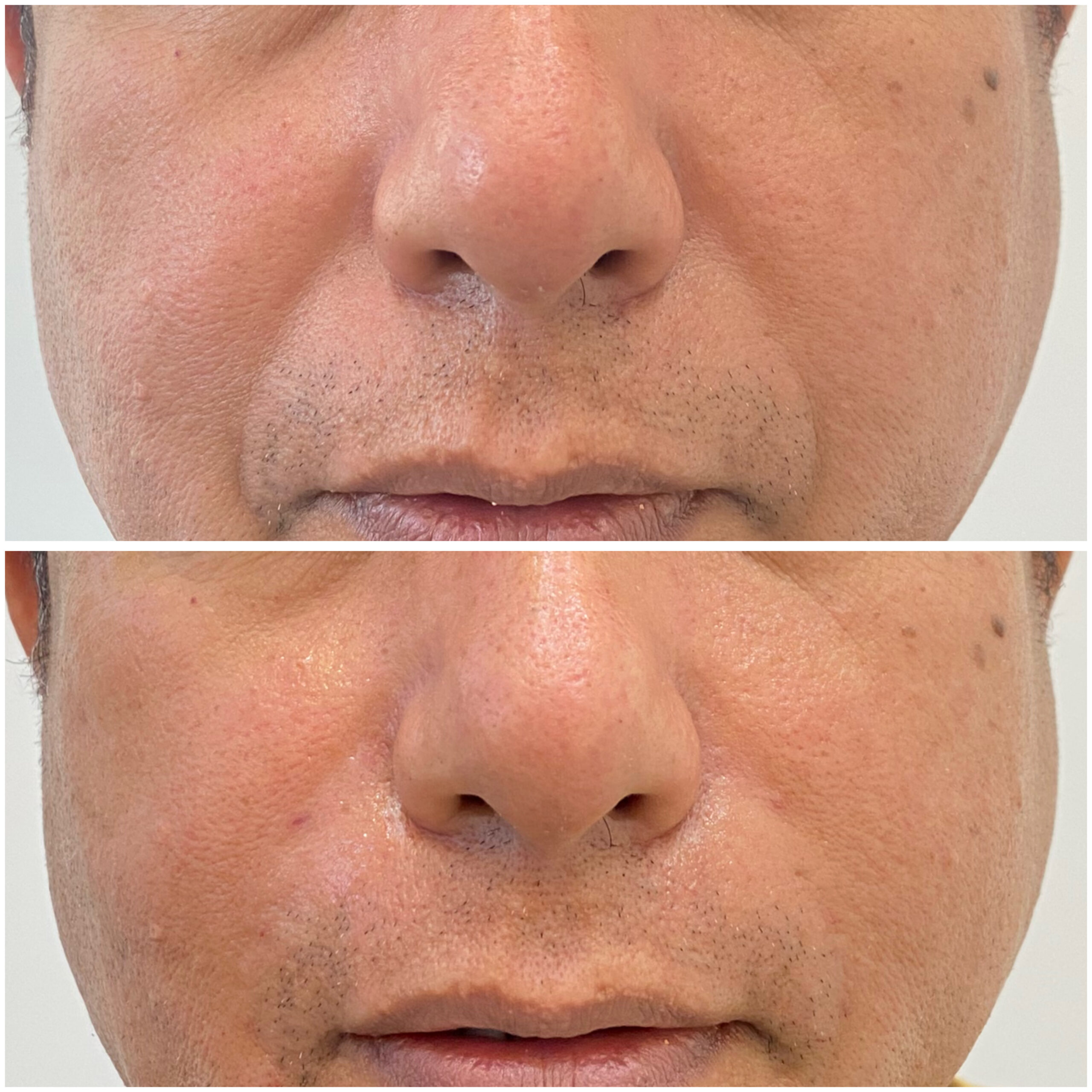 Smile Line filler 24-02-2024