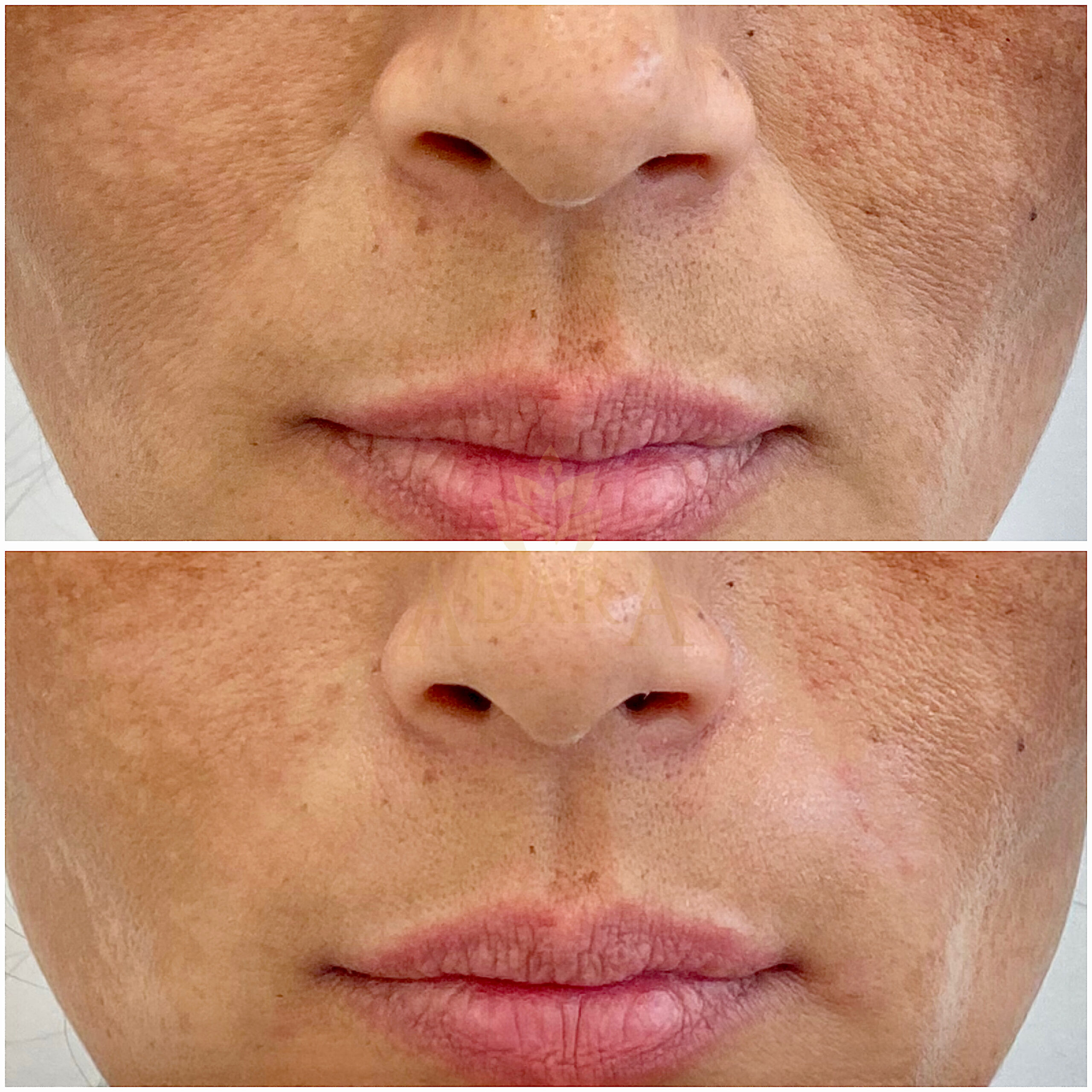 Smile line filler 11-03-2024