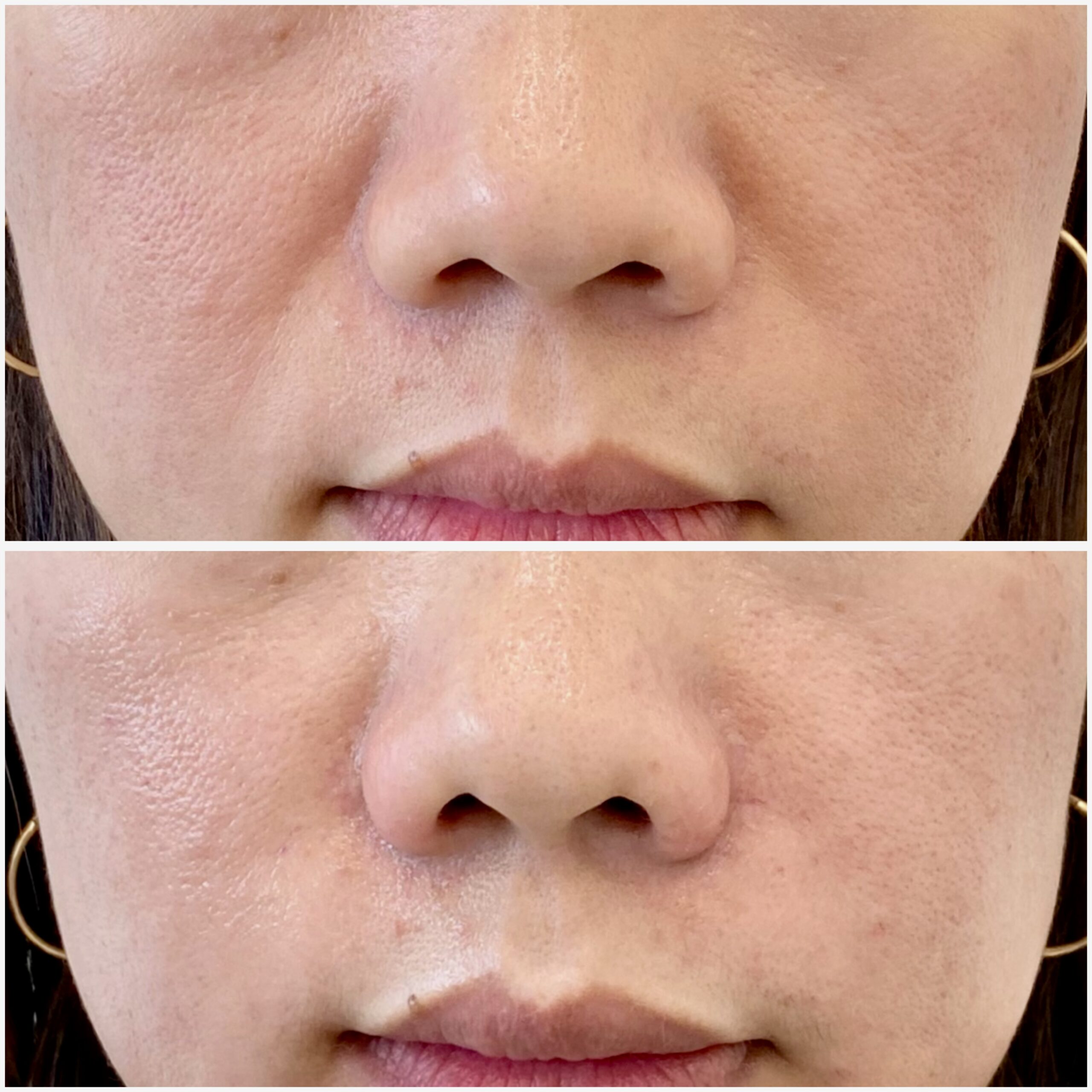 Smile line filler 26-02-2024