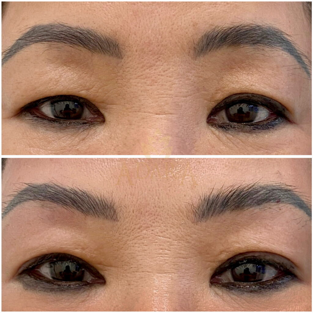 Thread Lifting Treatment 23-03-2024