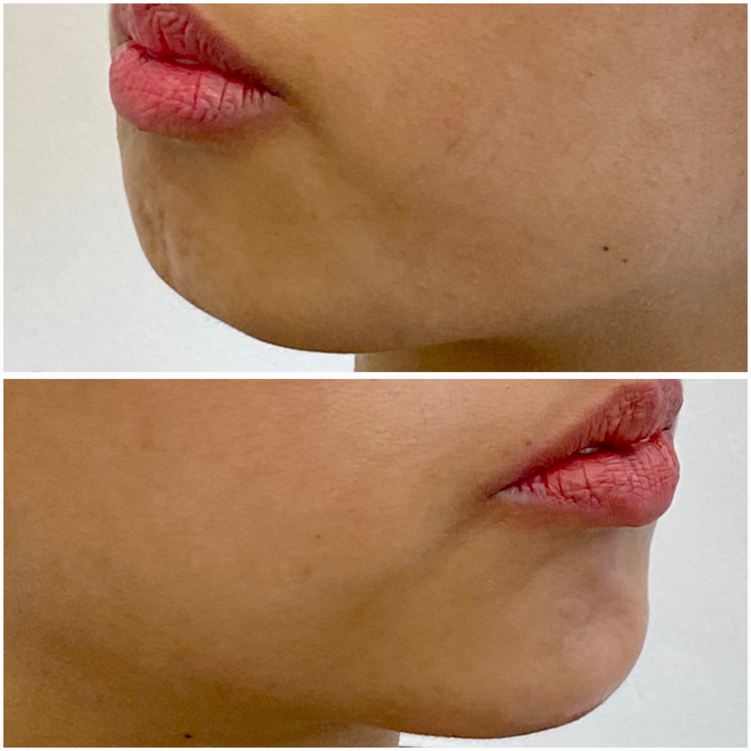 Chin Filler 08-03-2024 (1)