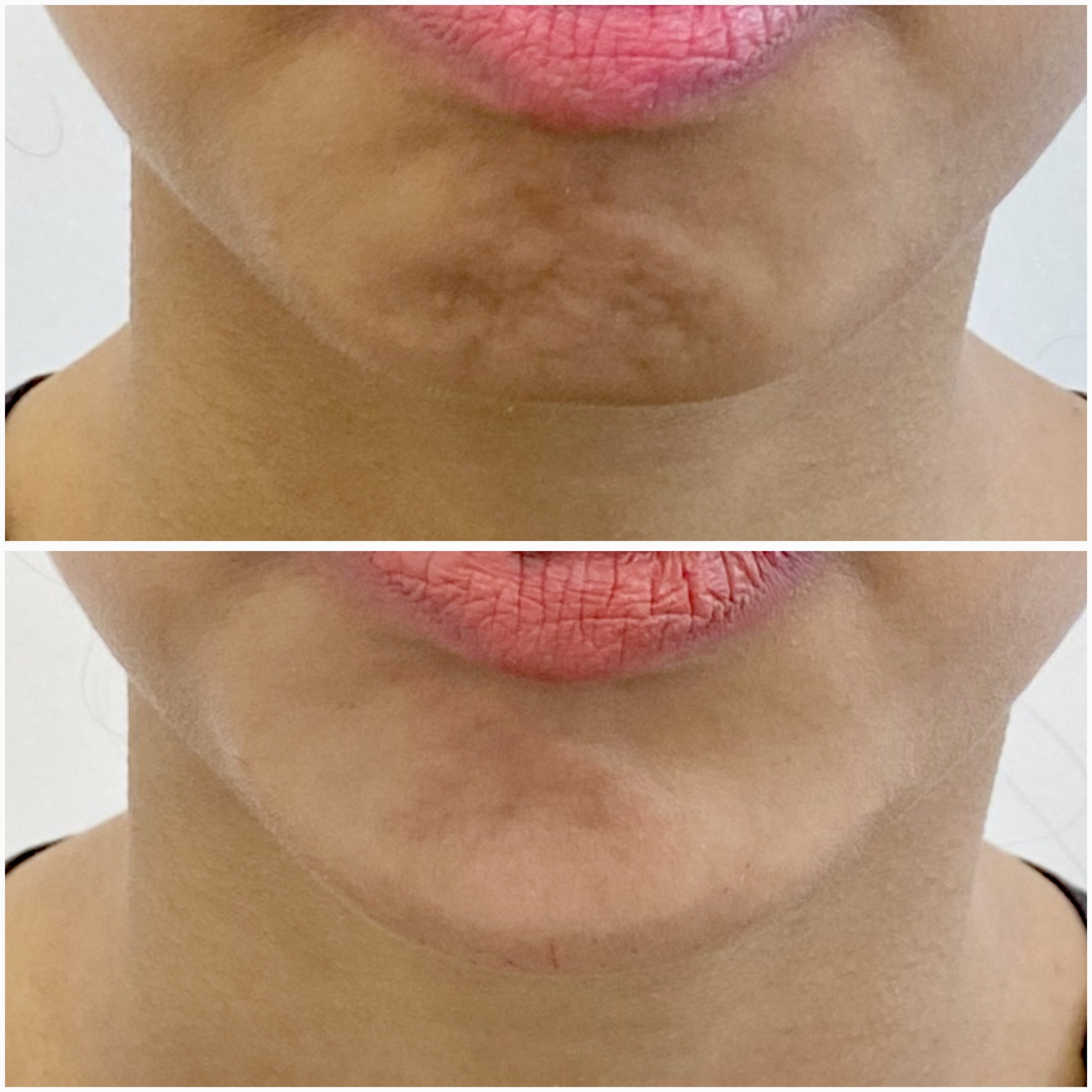 Chin filler 08-03-2024