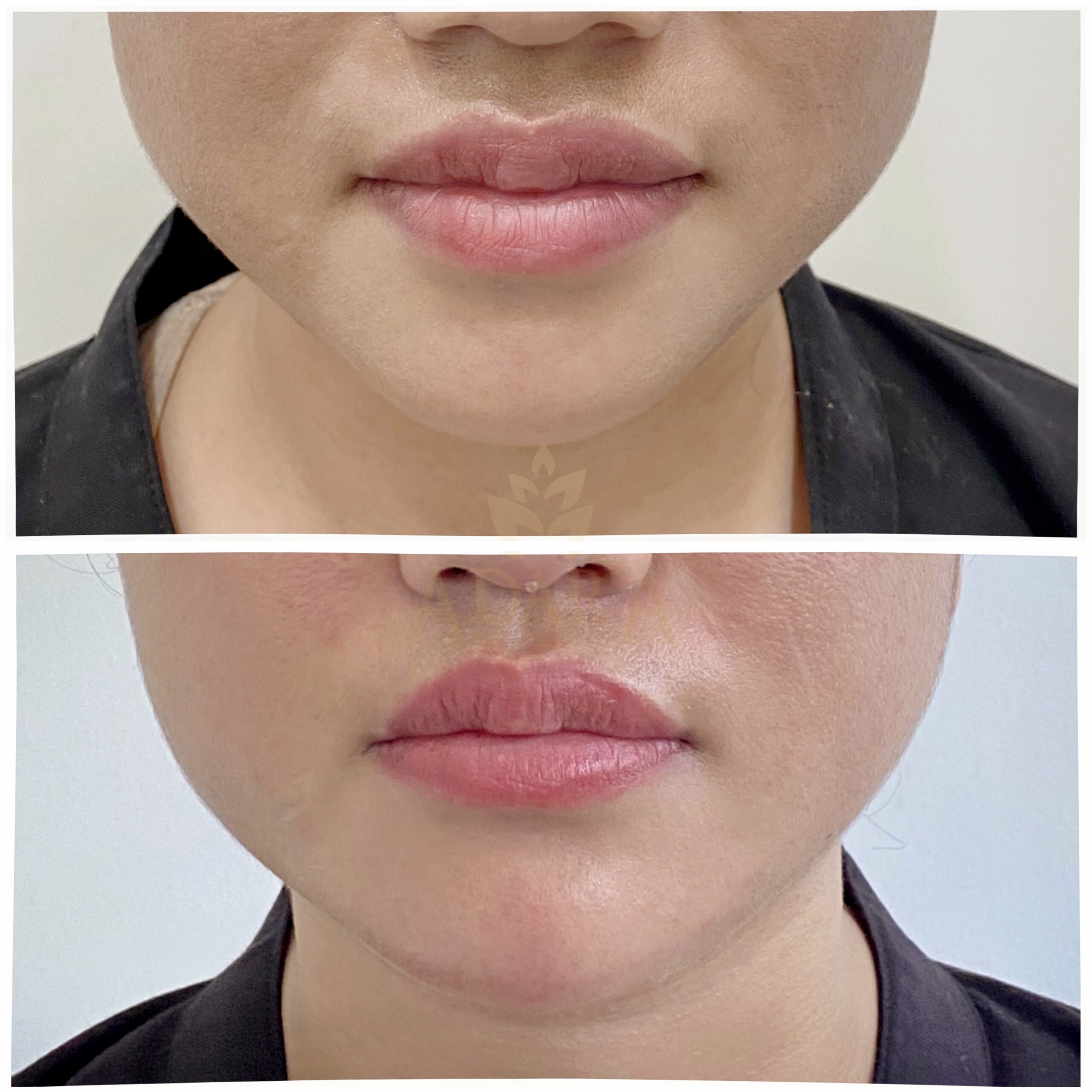 Chin filler 1 25-05-2024