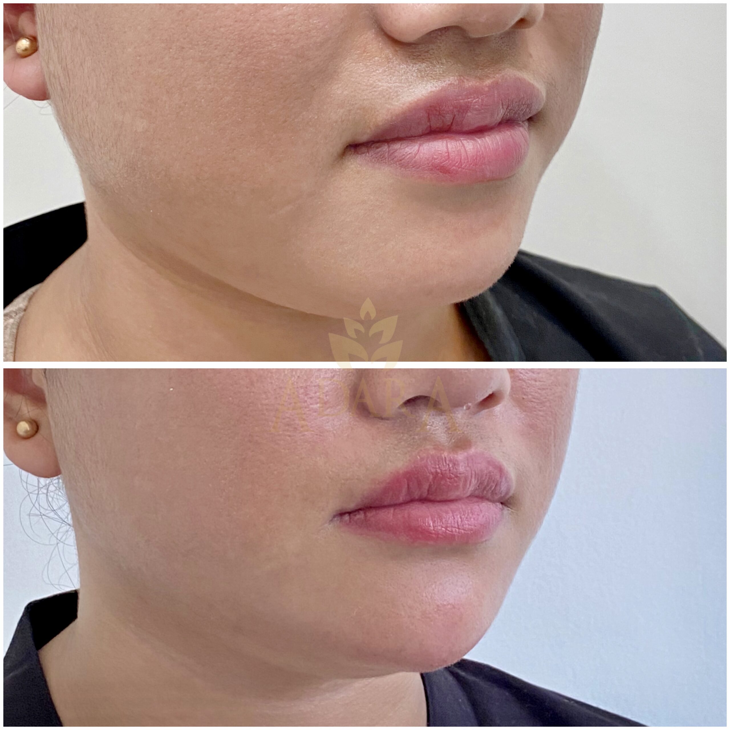 Chin filler 2 25-05-2024