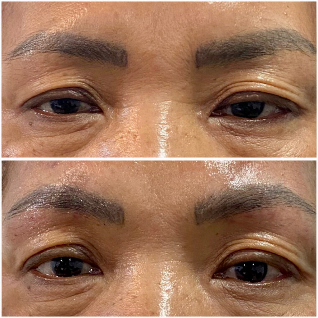 Droopy Eyelids Thread lifting 05-03-2024 (1)