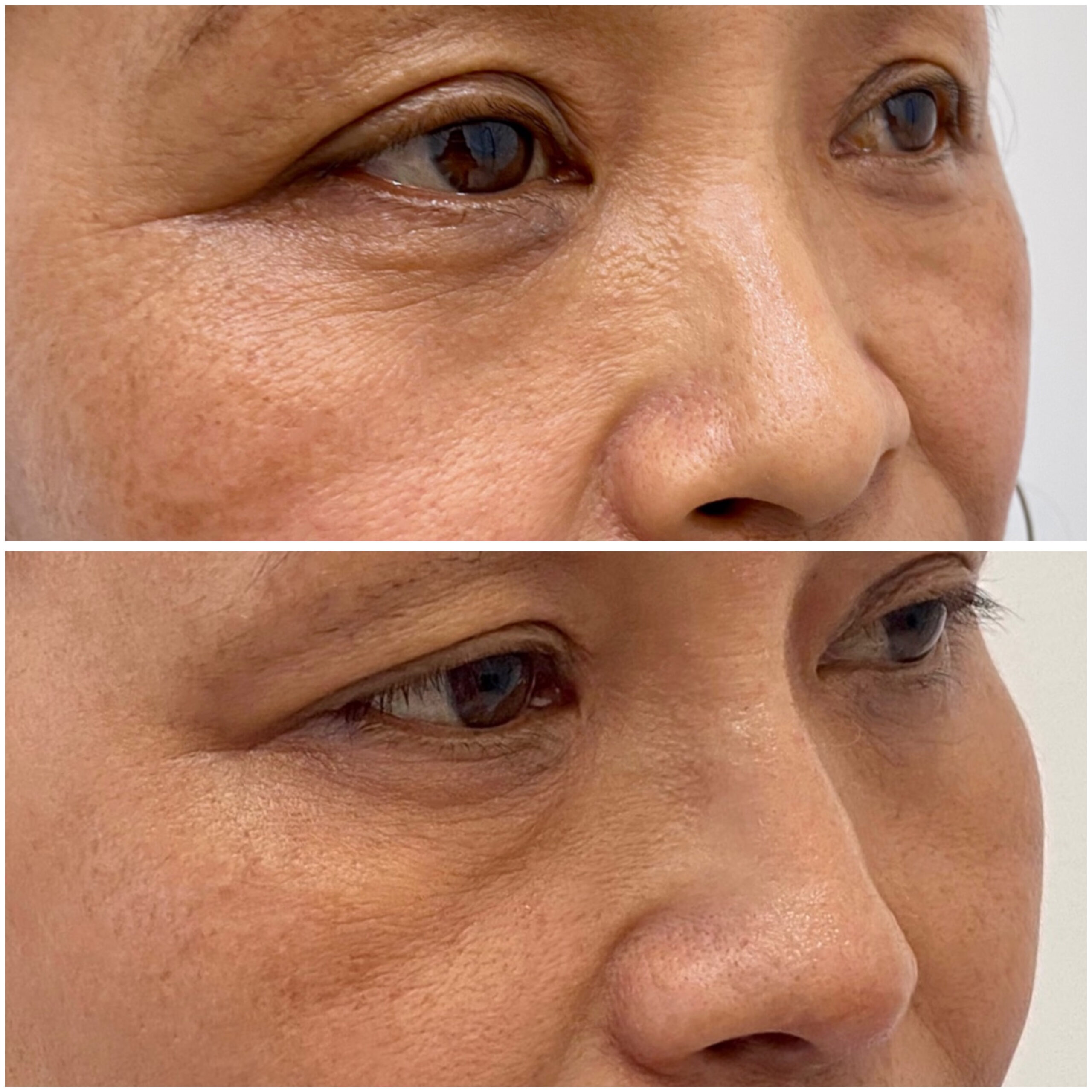 Nose Filler 13-03-2024