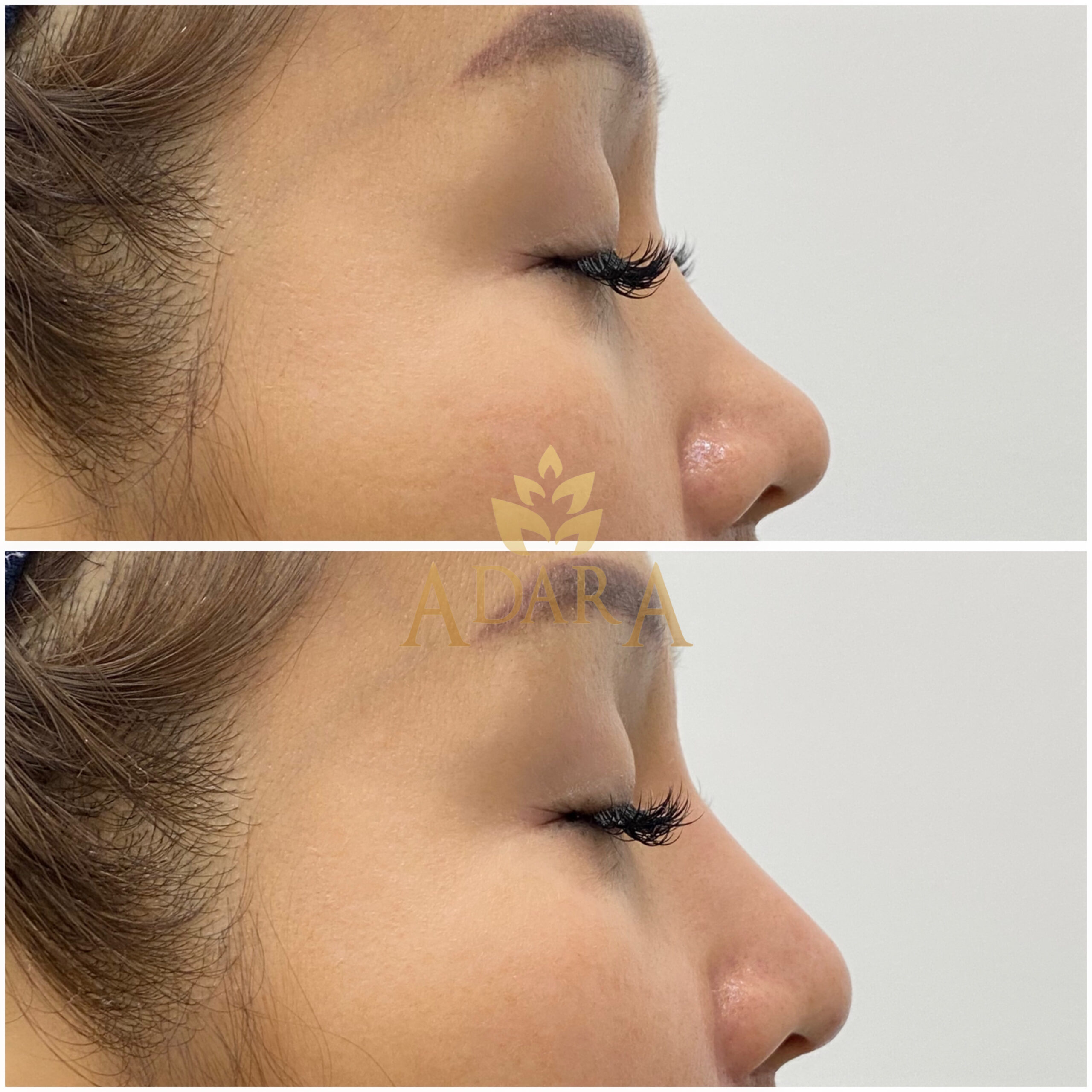 Nose Filler 21-03-2024