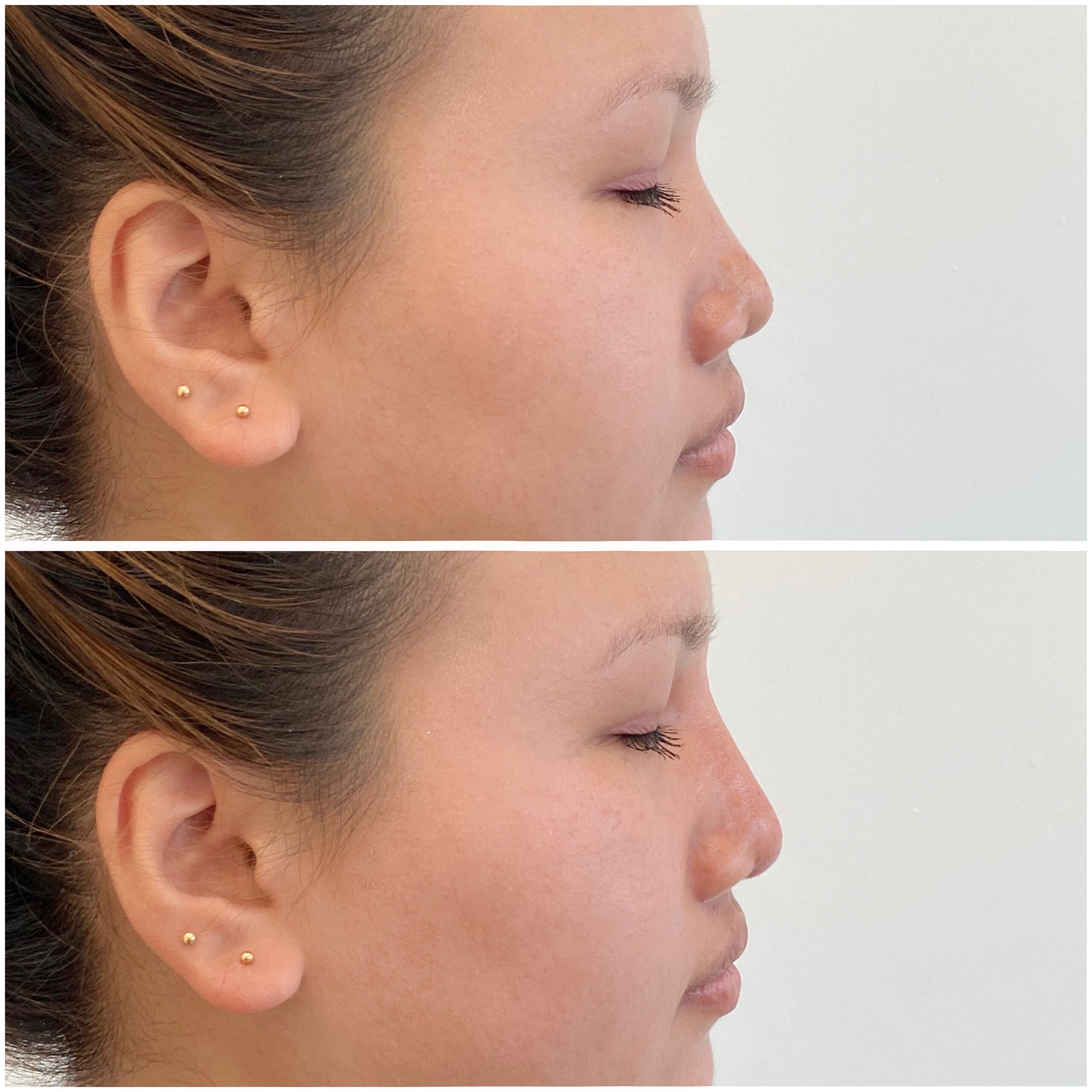 Nose Filler_Left 08-03-2024