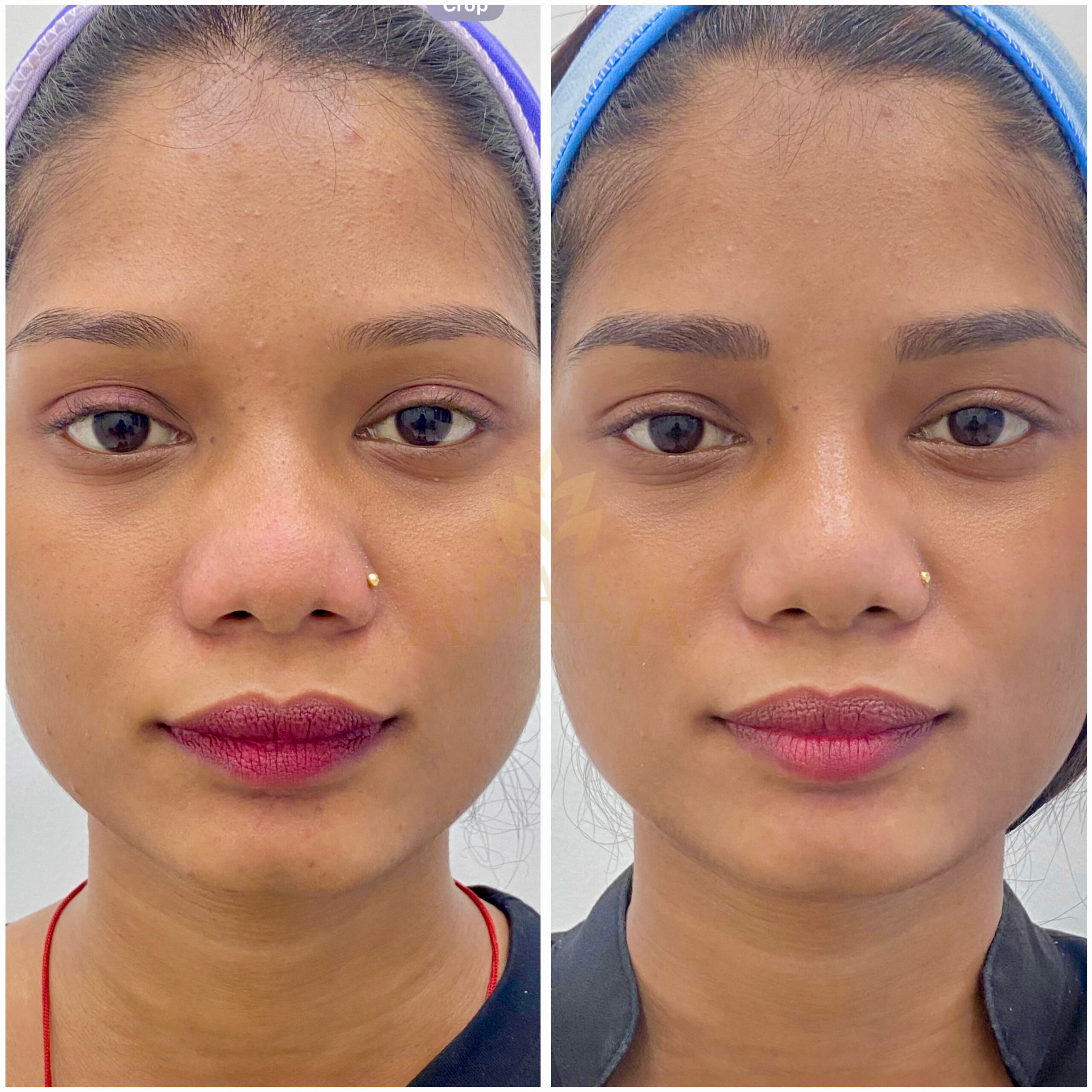 Nose filler 05-06-2024