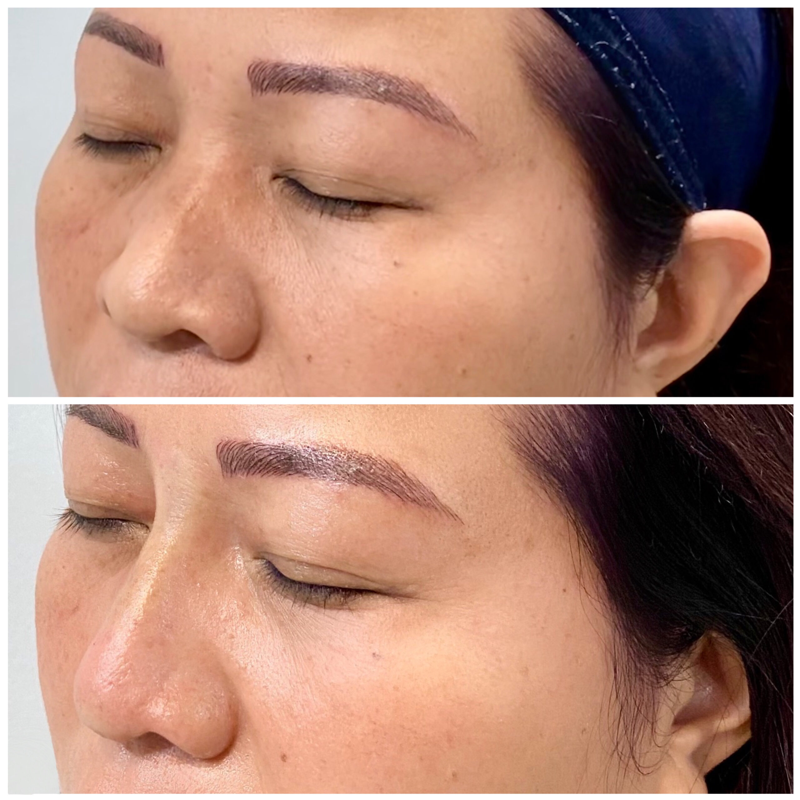 Nose filler