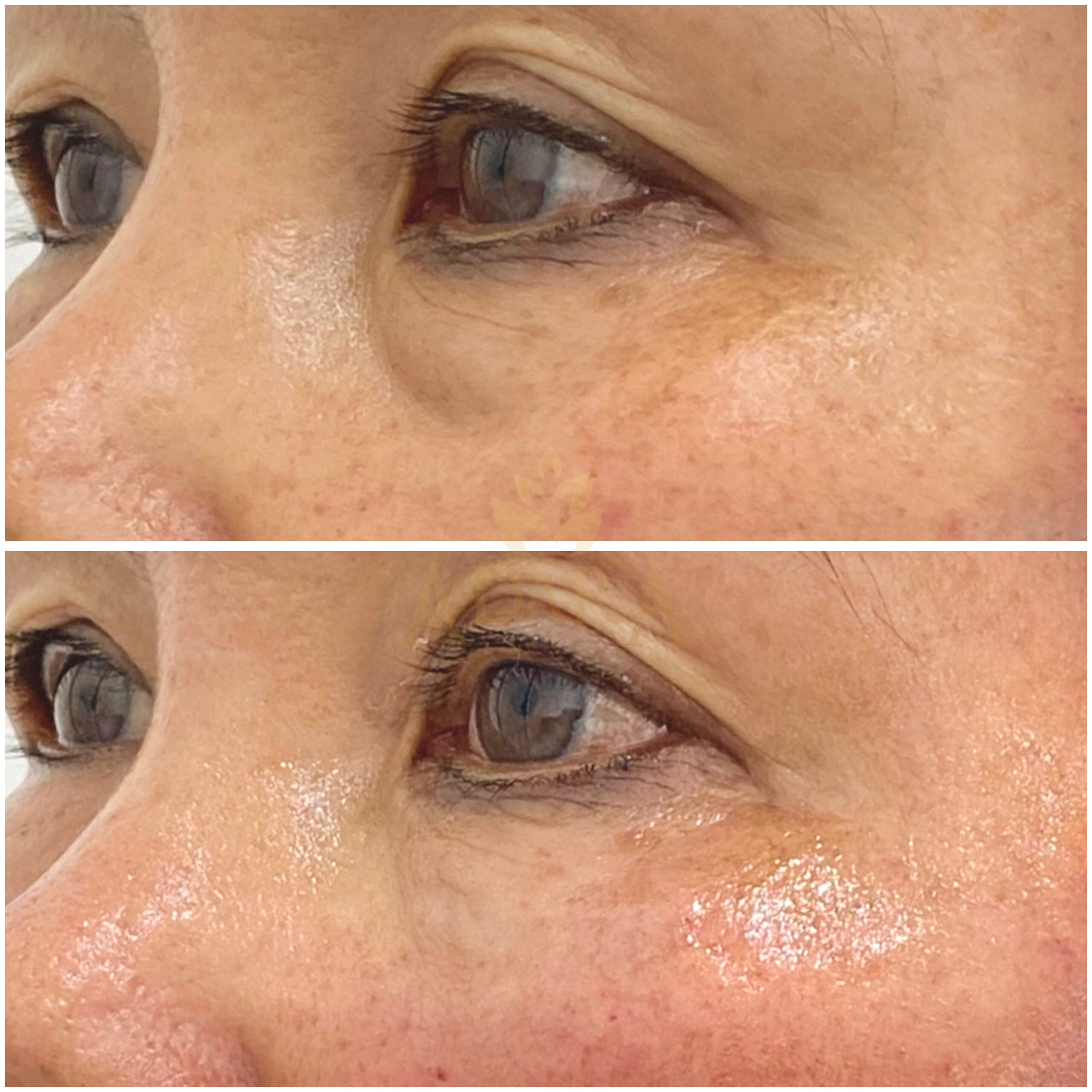 Under Eye Filler 11-03-2024