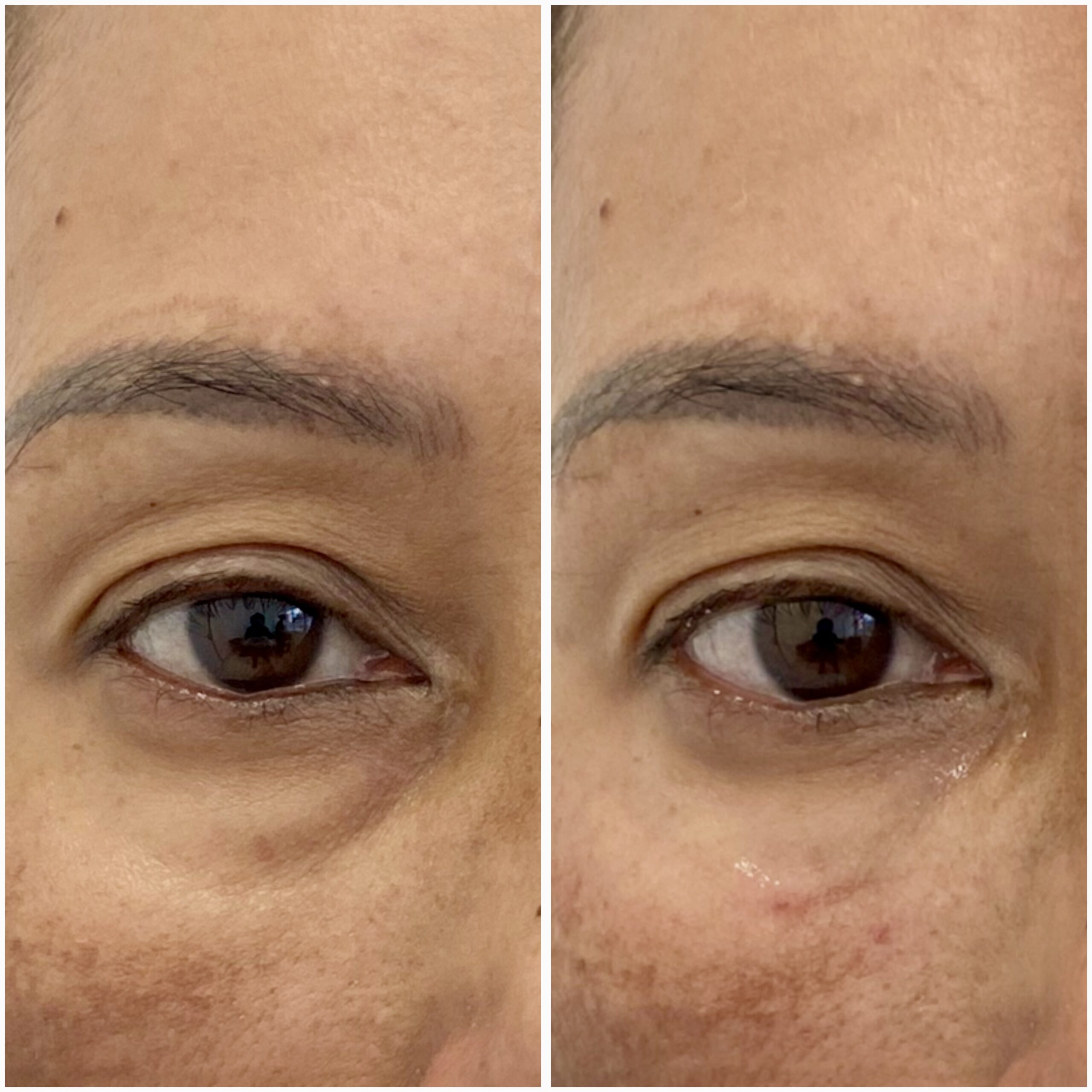 Under Eye Filler 18-03-2024
