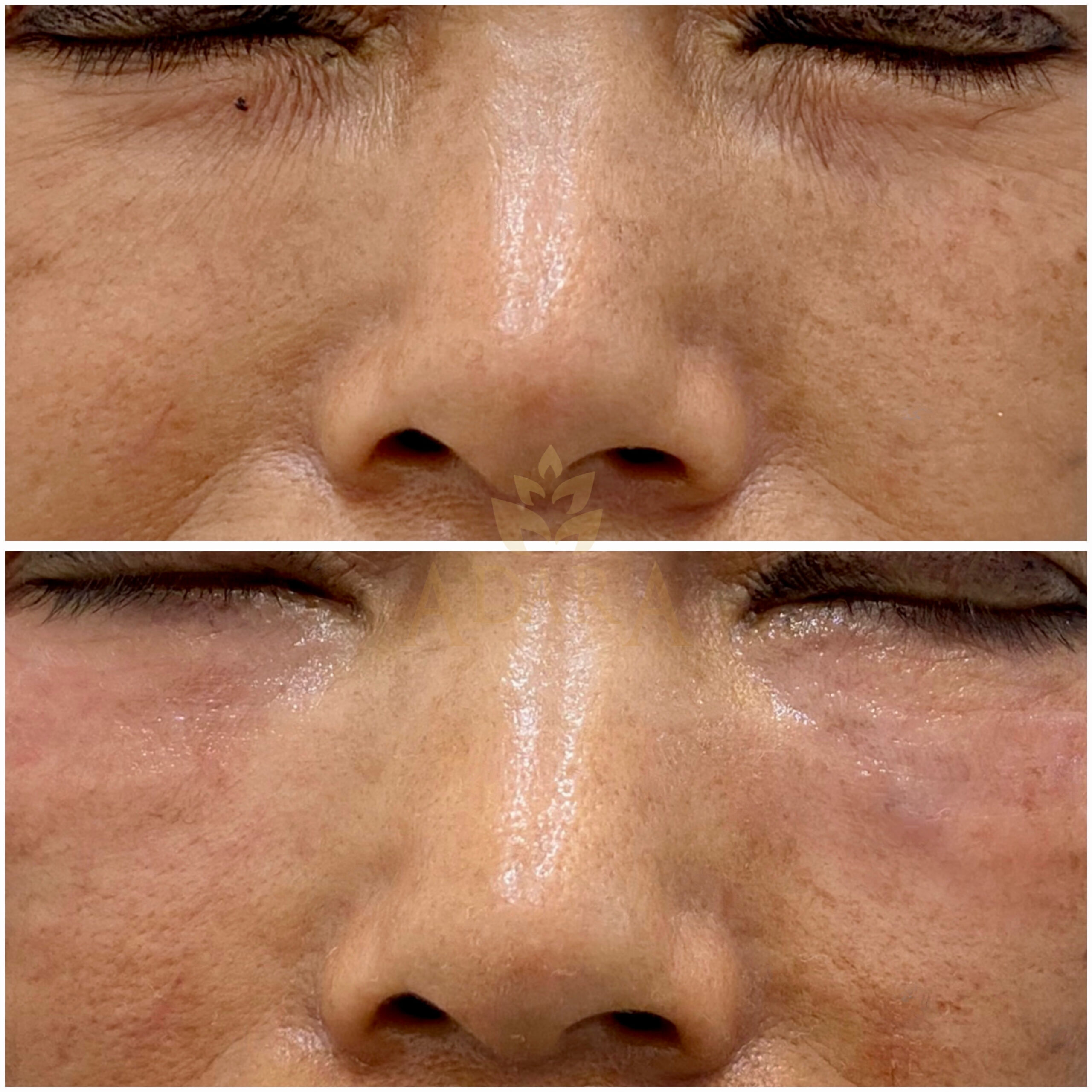 Under Eyes Filler 21-03-2024