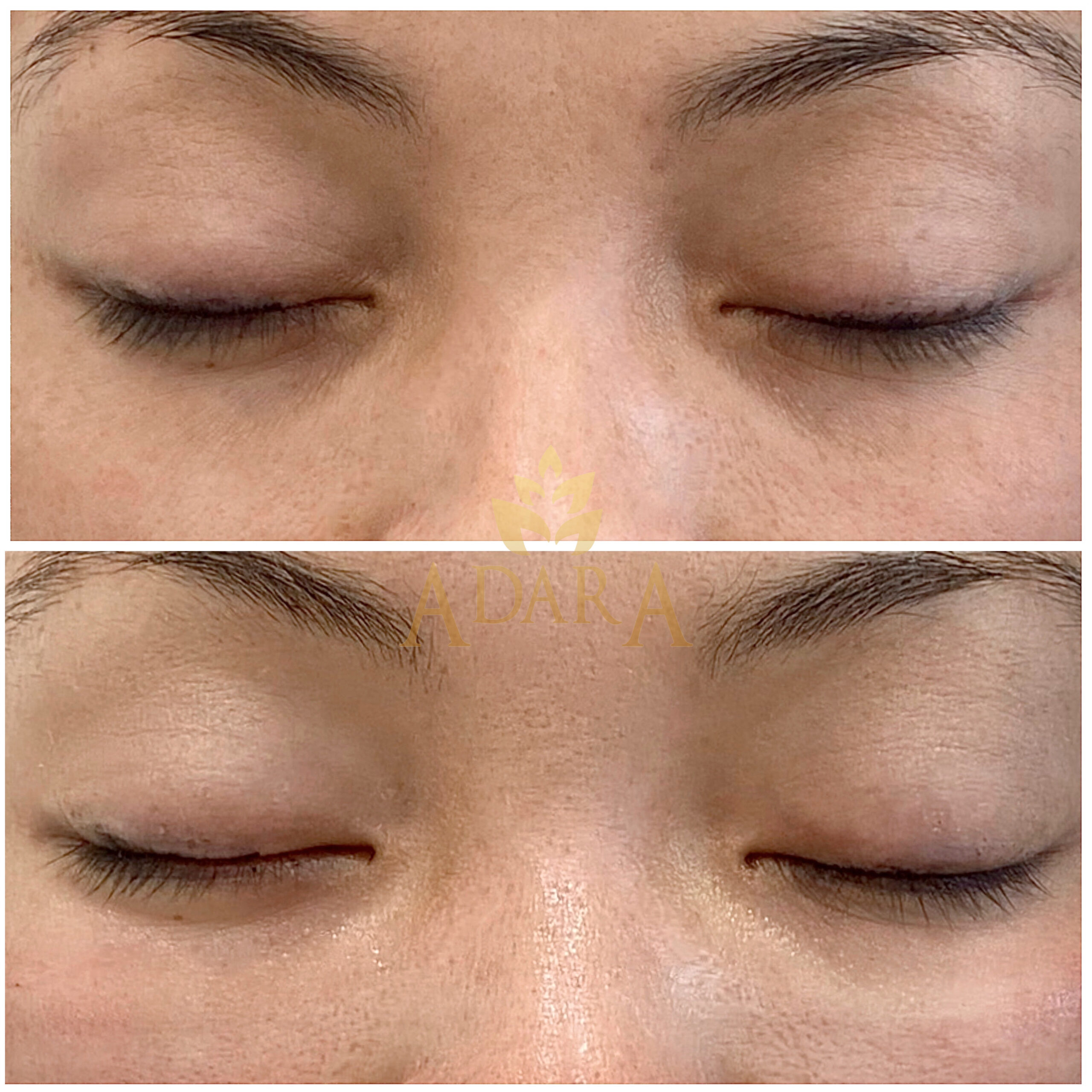 Under Eyes Filler_ dark circle and fine wrinkle focused 14-03-2024