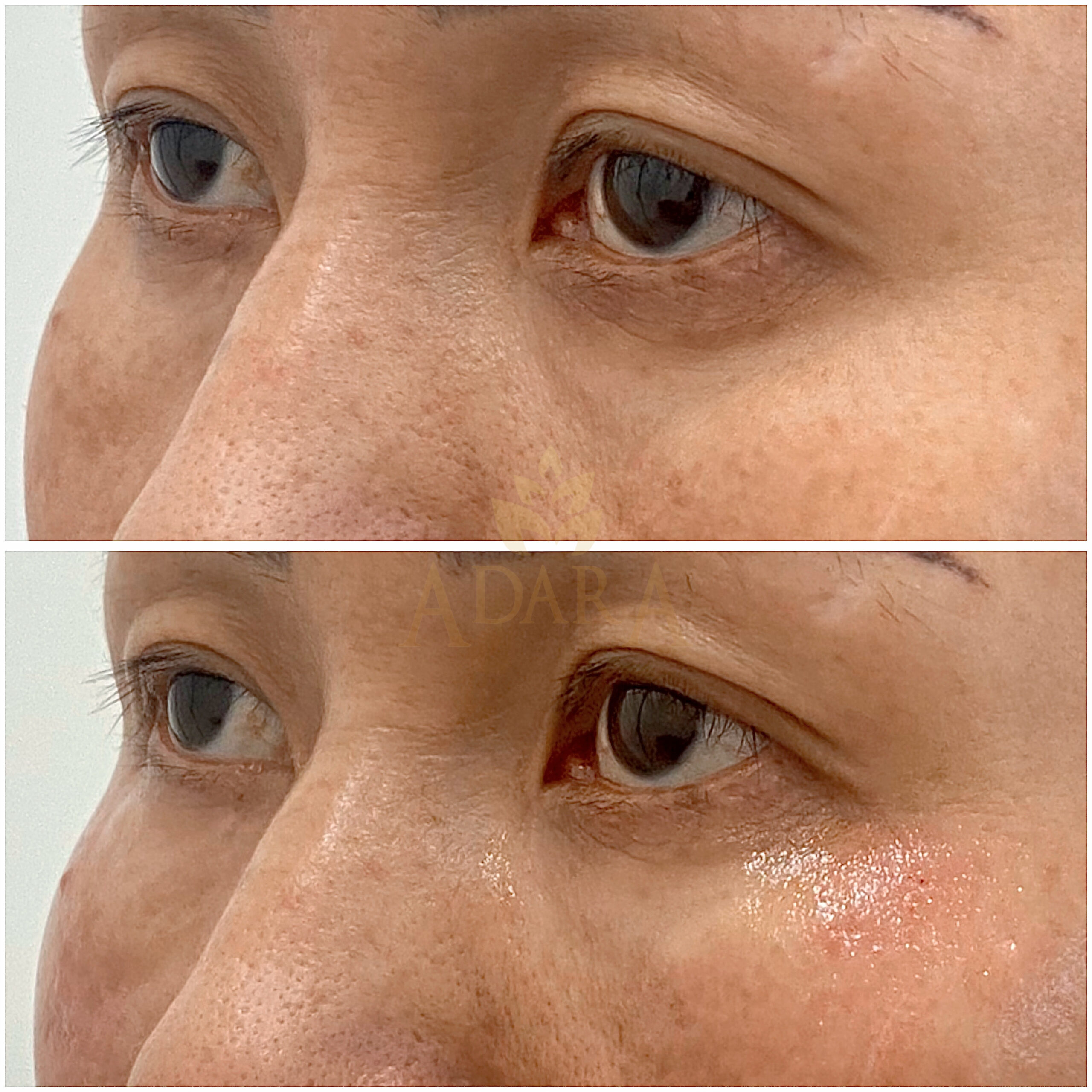 Under Eyes Filler_Un-even skin and dark circle 14-03-2024 (1)